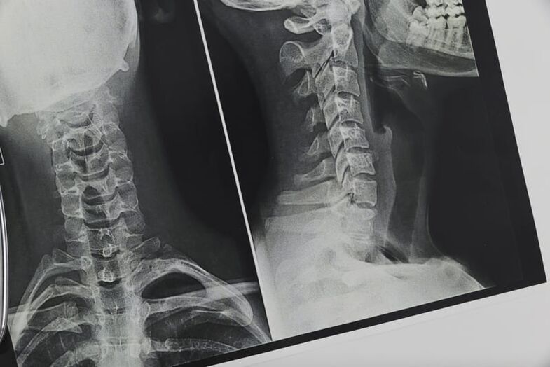 Osteoxondrozdan ta'sirlangan servikal o'murtqa rentgenogrammasi