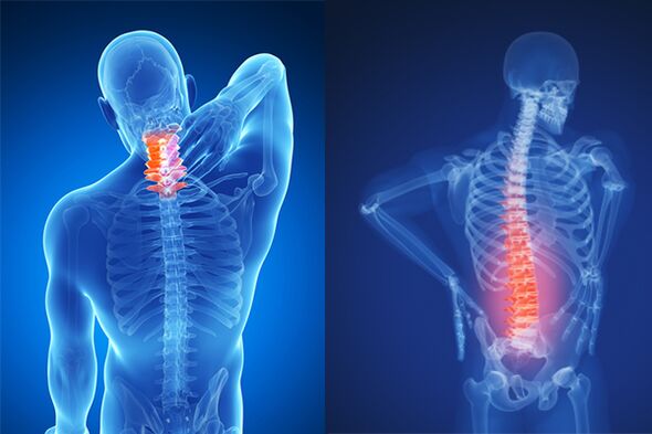 Servikal va bel umurtqalarining osteoxondrozi