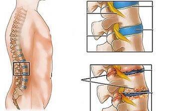 Lumchining osteokondrozining sabablari