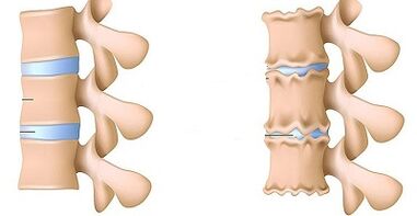 Lumchning osteokondrozining mavjudligini qanday aniqlash mumkin